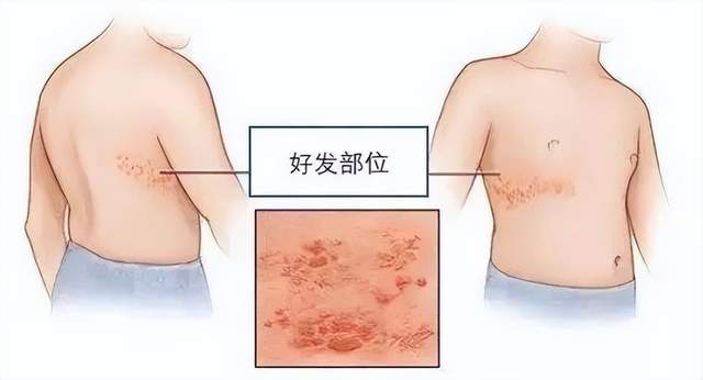 最新疱疹疗法，突破传统，开启治疗新篇章