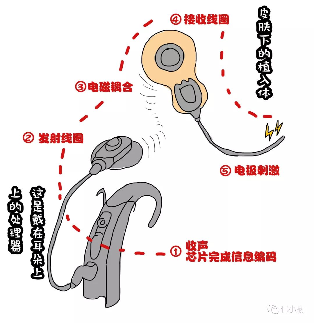 最新款人工耳蜗图片及其应用前景